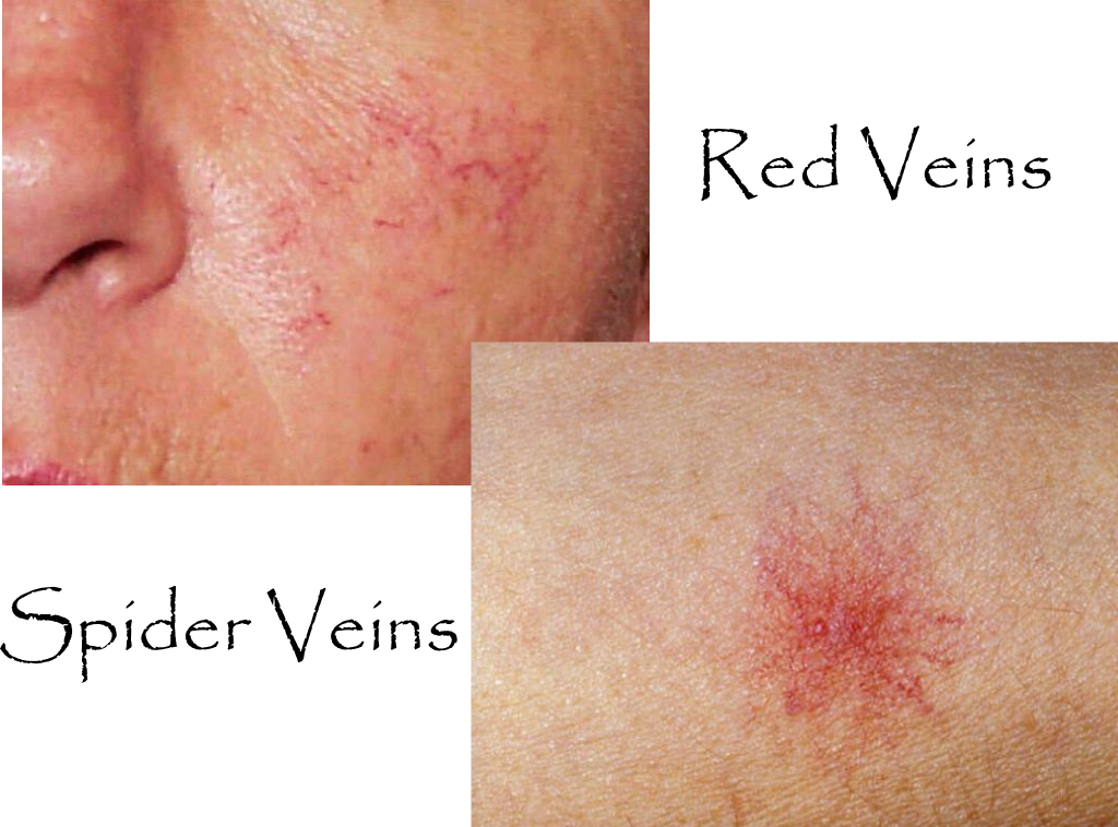 Red Veins and Spider Veins