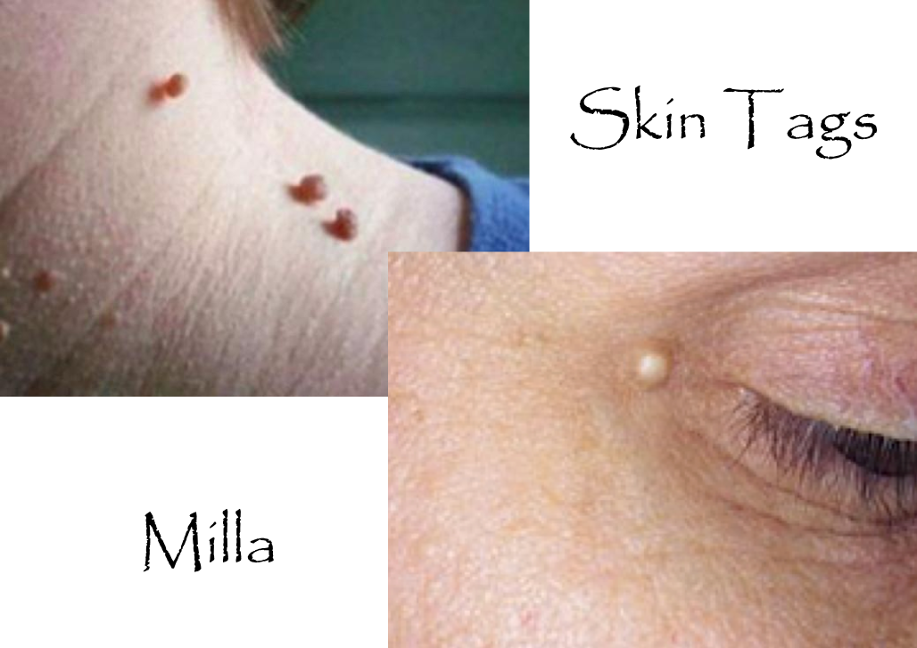 Other skin compliants